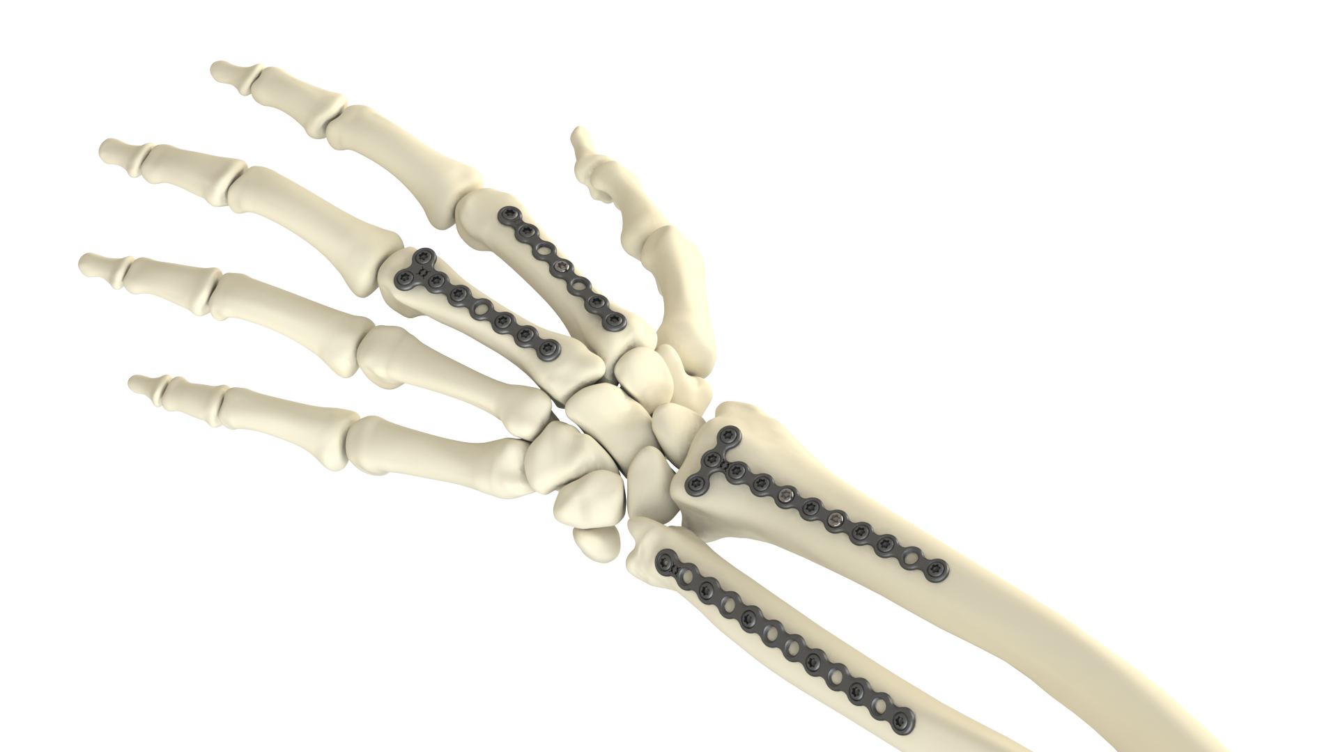 OIC Mini Fragment Plating System for Hand and Wrist Trauma Surgery
