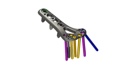 DRPx Distal Radius Volar Locking Plating System