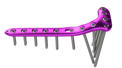 Proximal Tibia Lateral Locking Plating System