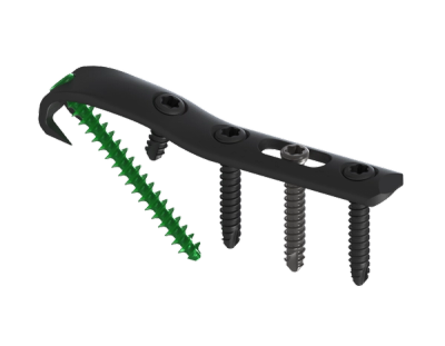 ANKx Ankle Fixation Plating System