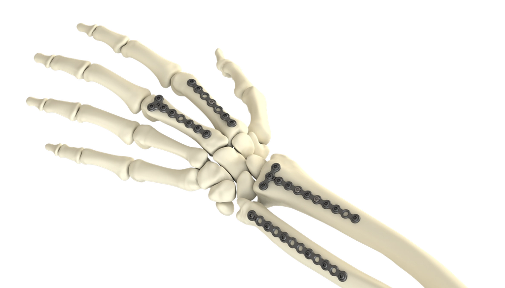 Mini Fragment Plating System for Hand and Wrist