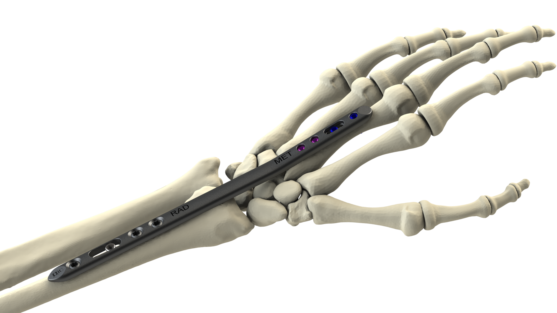 Dorsal Spanning Plate DSP Wrist Fixation