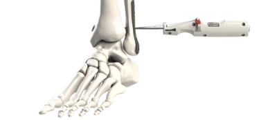 Flex-Fix Ankle Syndesmotic Repair System
